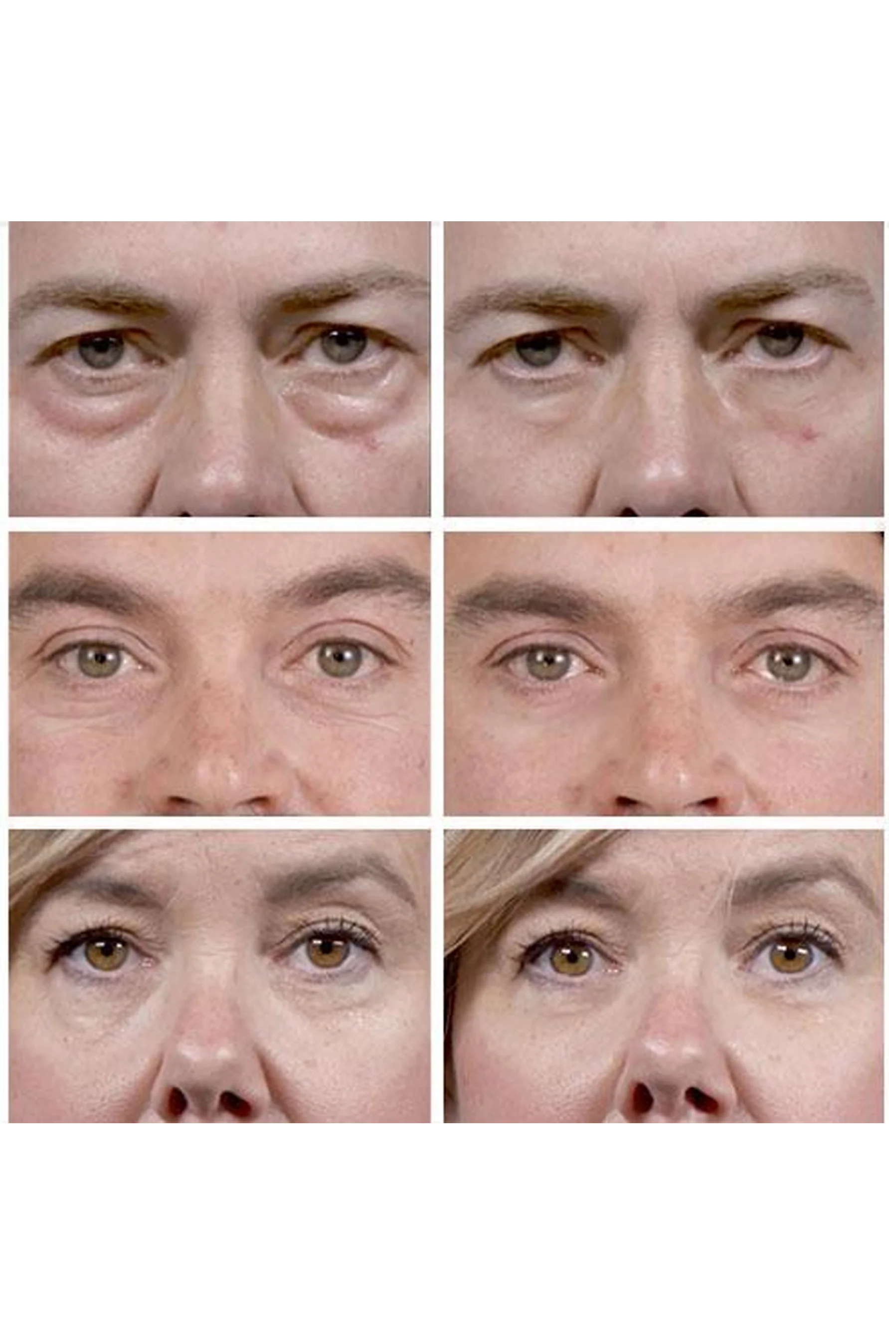 THIN LIZZY Puffy Eye Remover - Image 3